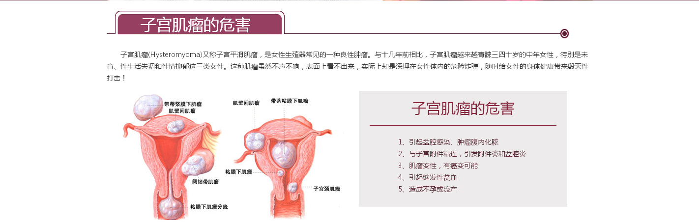子宫肌瘤损害女性健康 子宫肌瘤对女性的影响